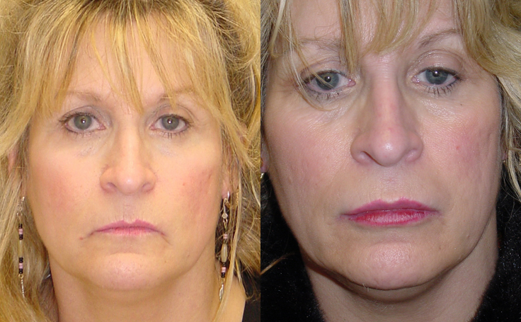 Before and after photo of an actual Lip Augmentation patient.