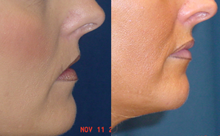 Before and after photo of an actual Lip Augmentation patient.