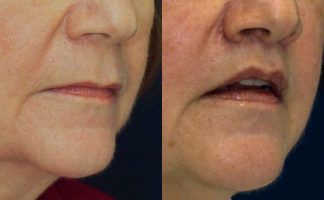 Before and after photo of an actual Lip Lift patient.