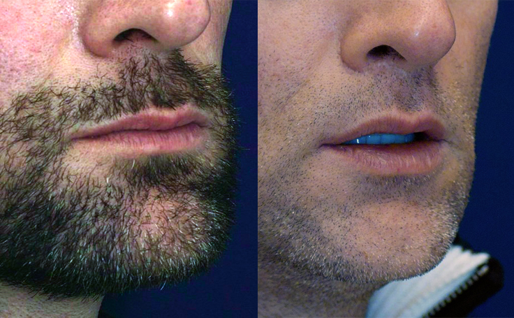 Before and after photo of an actual Lip Lift patient.