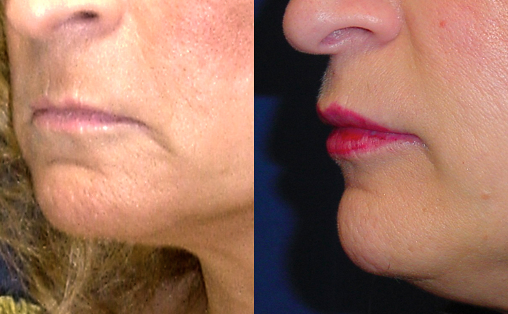 Before and after photo of an actual Lip Lift patient.