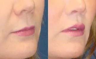 Before and after photo of an actual Lip Lift patient.