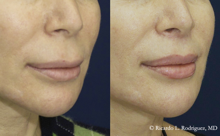 lip lift patient's before and after pictures