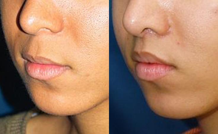 Before and after photo of an actual Lip Lift patient.