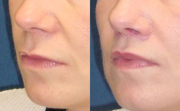 Before and after photo of an actual Lip Lift patient.