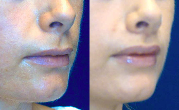 Before and after photo of an actual Lip Lift patient.