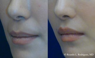 Before and after photo of an actual Lip Lift patient.