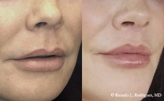 Before and after photo of an actual Lip Lift patient.