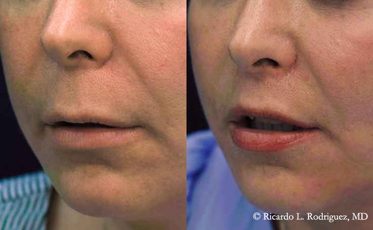 patient photo before and after her upper and corner lip lift