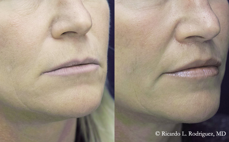 Before and after photo of an actual Lip Lift patient.