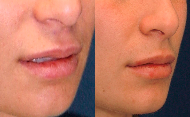 Before and after photo of an actual Lip Lift patient.