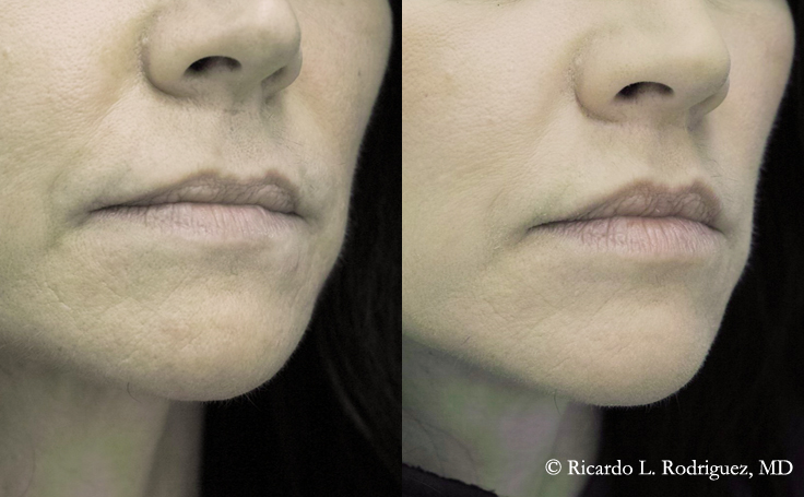 Before and after photo of an actual Lip Lift patient.