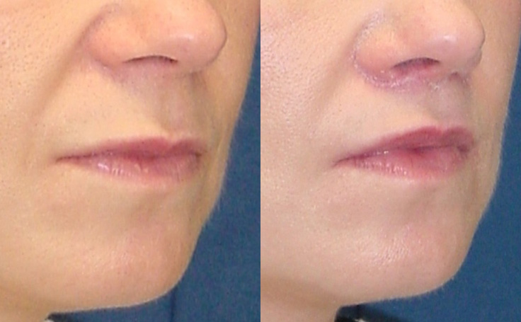 Before and after photo of an actual Lip Lift patient.