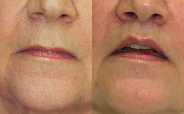 Before and after photo of an actual Lip Lift patient.