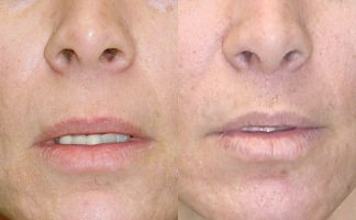 Before and after photo of an actual Lip Lift patient.