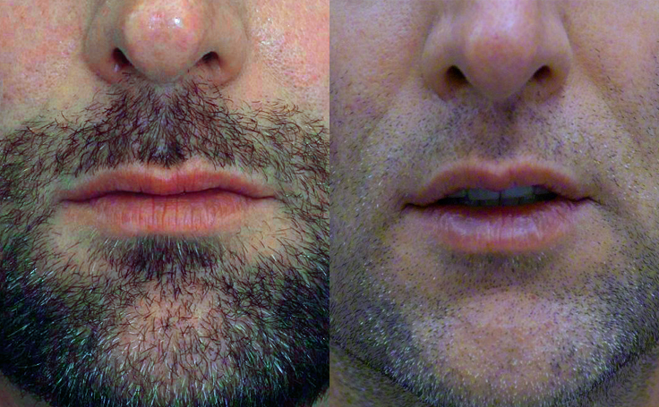 Before and after photo of an actual Lip Lift patient.