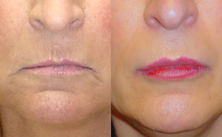 Before and after photo of an actual Lip Lift patient.