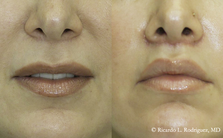 picture of a patient before and after her lip lift