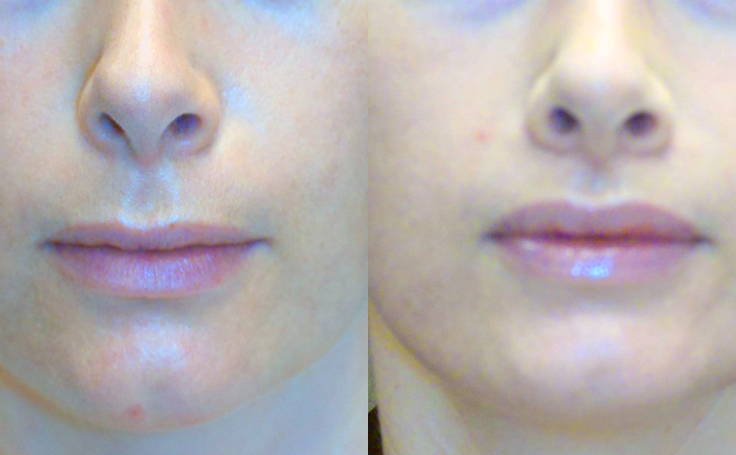 Before and after photo of an actual Lip Lift patient.