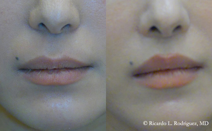 Before and after photo of an actual Lip Lift patient.