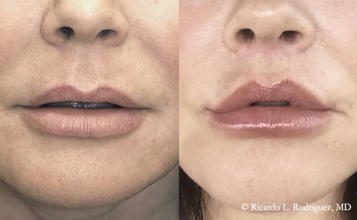 Before and after photo of an actual Lip Lift patient.