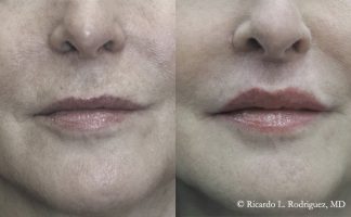 Before and after photo of an actual Lip Lift patient.