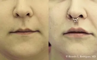 Before and after photo of an actual Lip Lift patient.