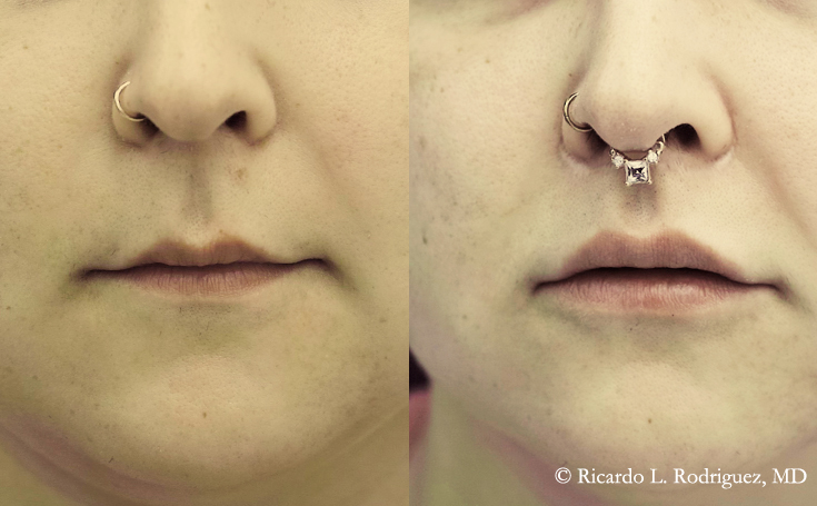 Before and after photo of an actual Lip Lift patient.