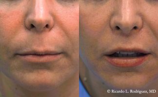 patient photo before and after an upper and corner lip lift