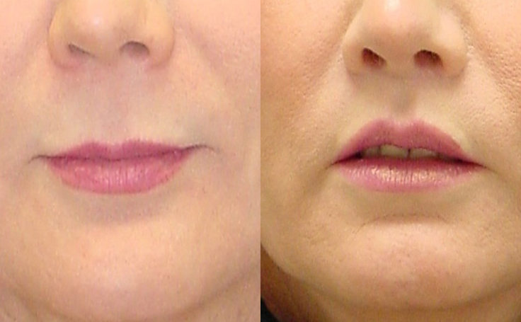 Before and after photo of an actual Lip Lift patient.