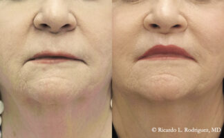 Before and after lip lift at rest in a 68-year-old woman, showing shortened philtrum and improved lip definition.