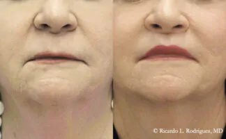 Before and after lip lift at rest in a 68-year-old woman, showing shortened philtrum and improved lip definition.