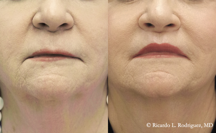 Before and after lip lift at rest in a 68-year-old woman, showing shortened philtrum and improved lip definition.