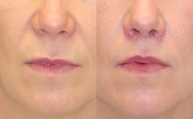 Before and after photo of an actual Lip Lift patient.