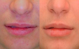 Before and after photo of an actual Lip Lift patient.