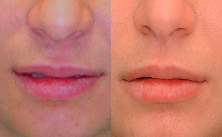 Before and after photo of an actual Lip Lift patient.