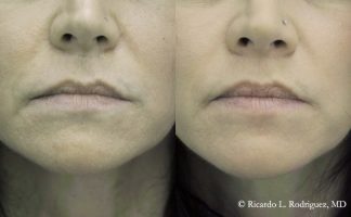 Before and after photo of an actual Lip Lift patient.