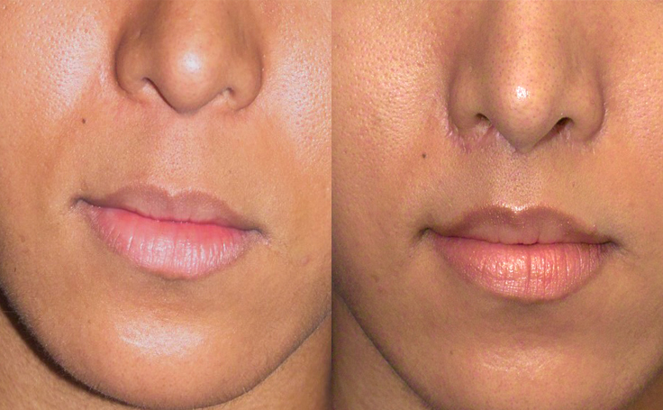 Before and after photo of an actual Lip Lift patient.