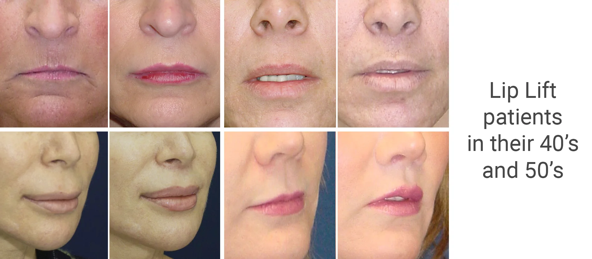 Transformative Advances in Lip Lift Cosmetic Procedures