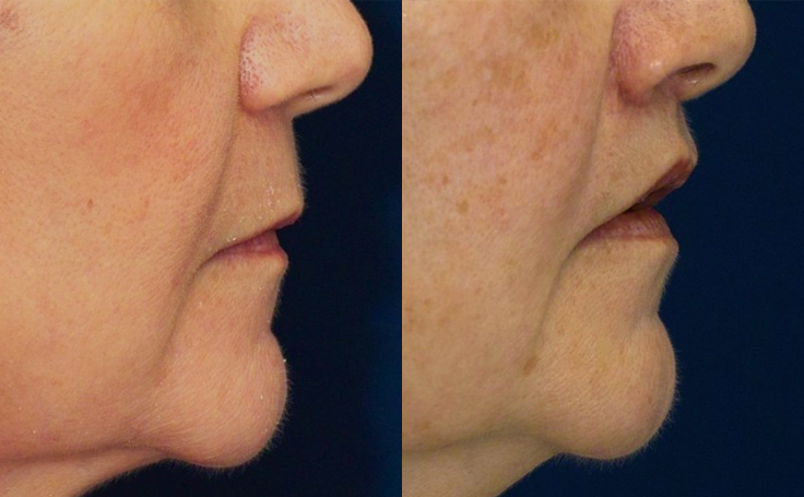 Before and after photo of an actual Lip Lift patient.