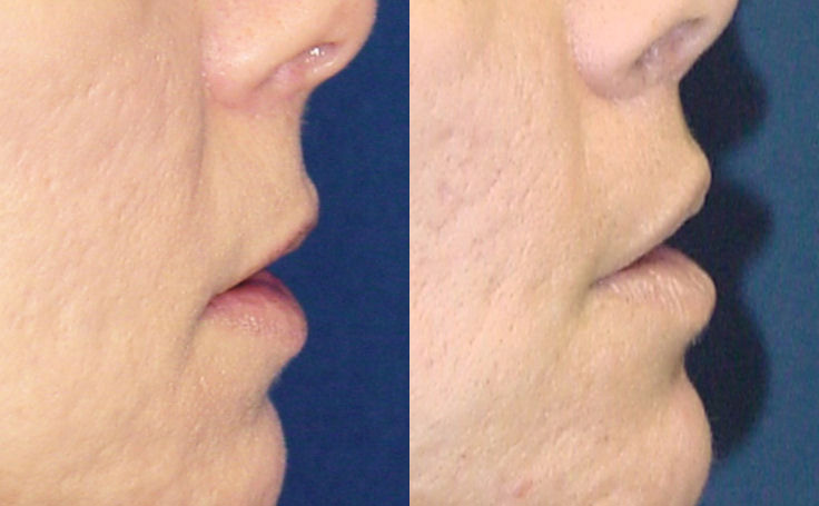 Before and after photo of an actual Lip Lift patient.