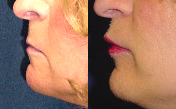 Before and after photo of an actual Lip Lift patient.