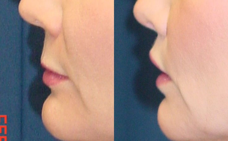 Before and after photo of an actual Lip Lift patient.