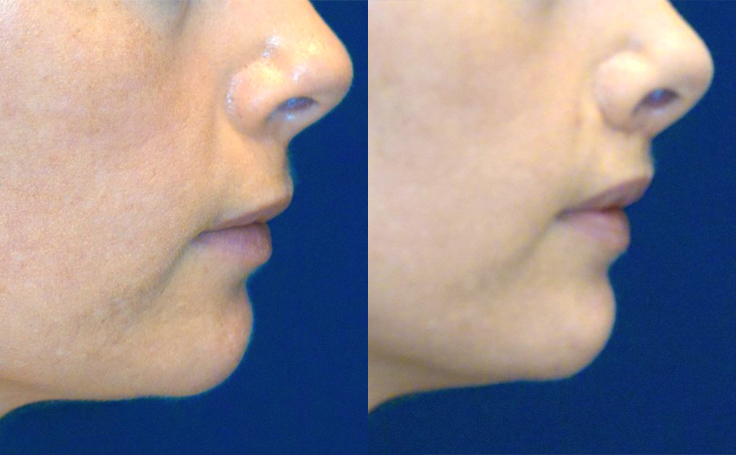 Before and after photo of an actual Lip Lift patient.