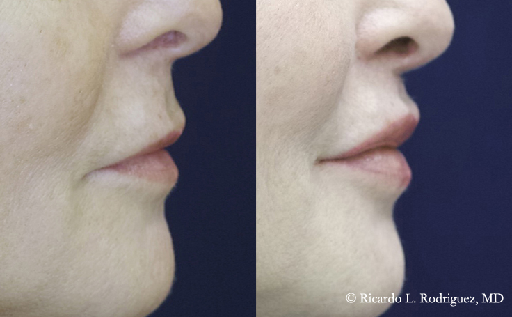 Before and after photo of an actual Lip Lift patient.