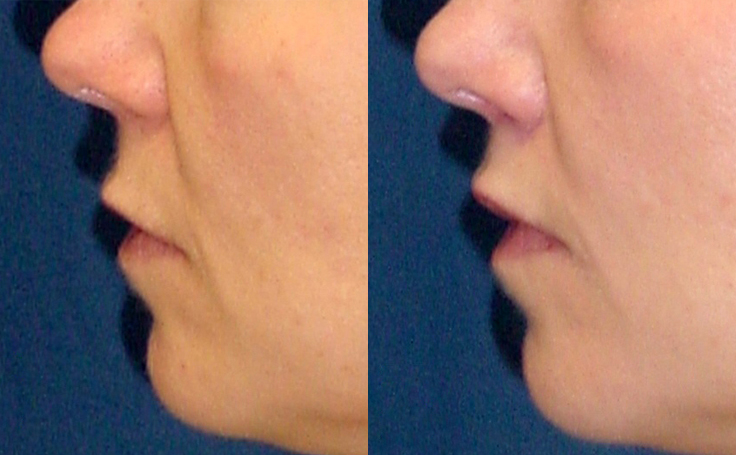 Before and after photo of an actual Lip Lift patient.