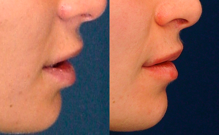 Before and after photo of an actual Lip Lift patient.