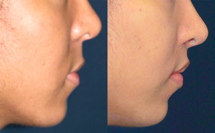 Before and after photo of an actual Lip Lift patient.