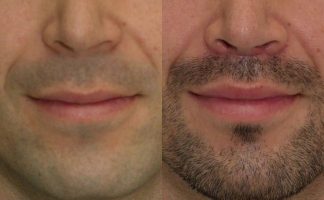 Before and after photo of an actual Lip Lift patient.