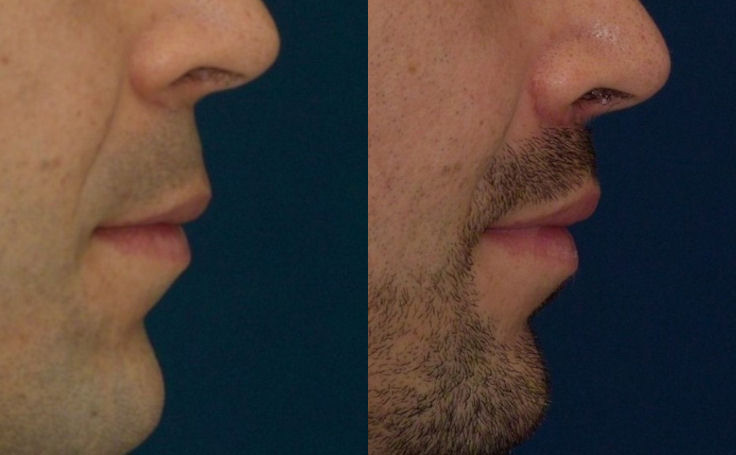 Before and after photo of an actual Lip Lift patient.